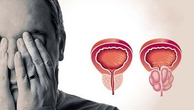 Sebab pembangunan prostatitis pada lelaki