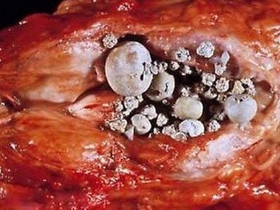 Batu dalam kelenjar prostat dengan prostatitis kalkulus