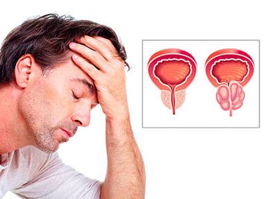 Gejala prostatitis membimbangkan seorang lelaki