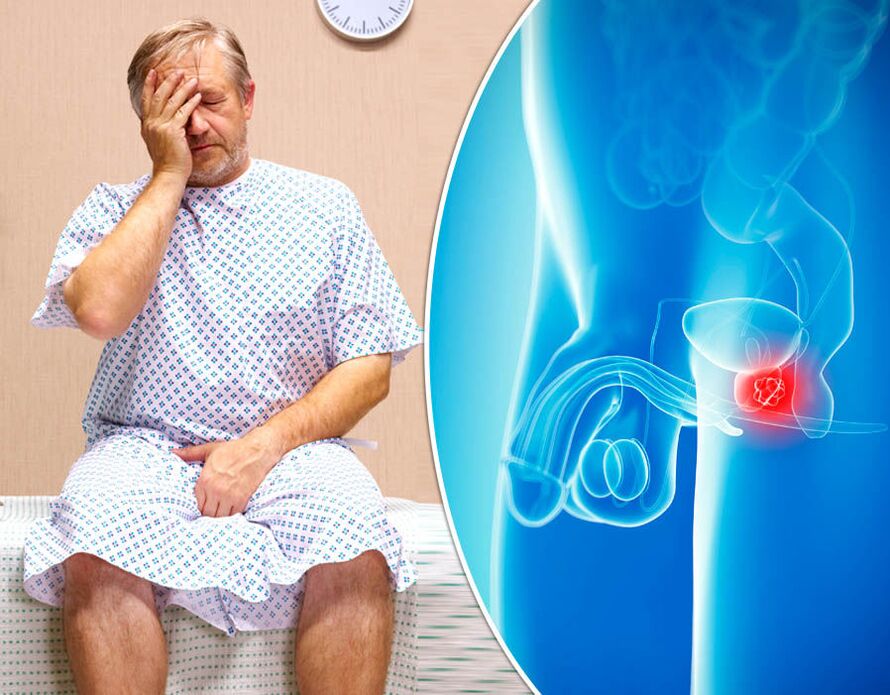 Seorang lelaki dengan prostatitis disahkan menghidap penyakit